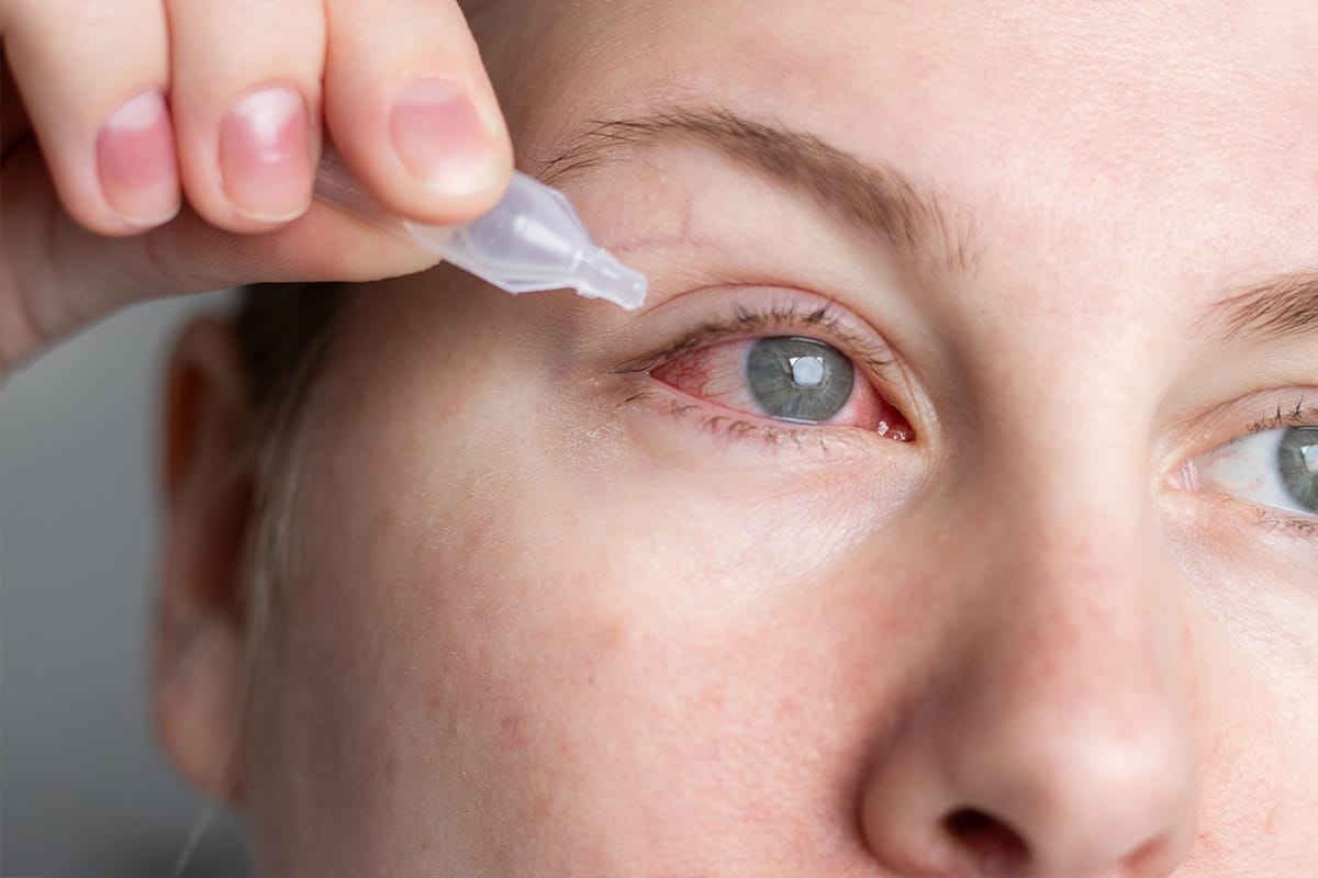 Mujer con el ojo rojo aplicándose gotas en el ojo.