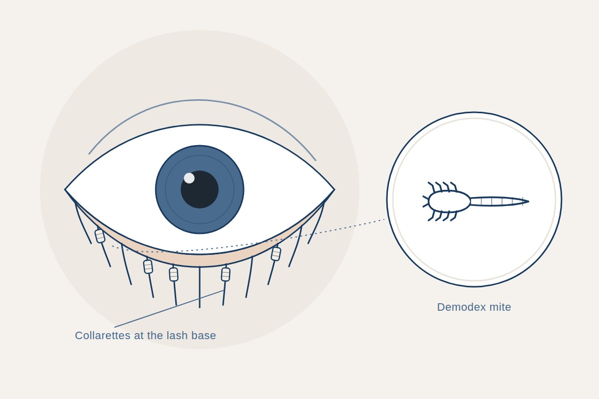 Illustration of an eyelid margin with collarettes at the base of the lashes and a magnified Demodex mite