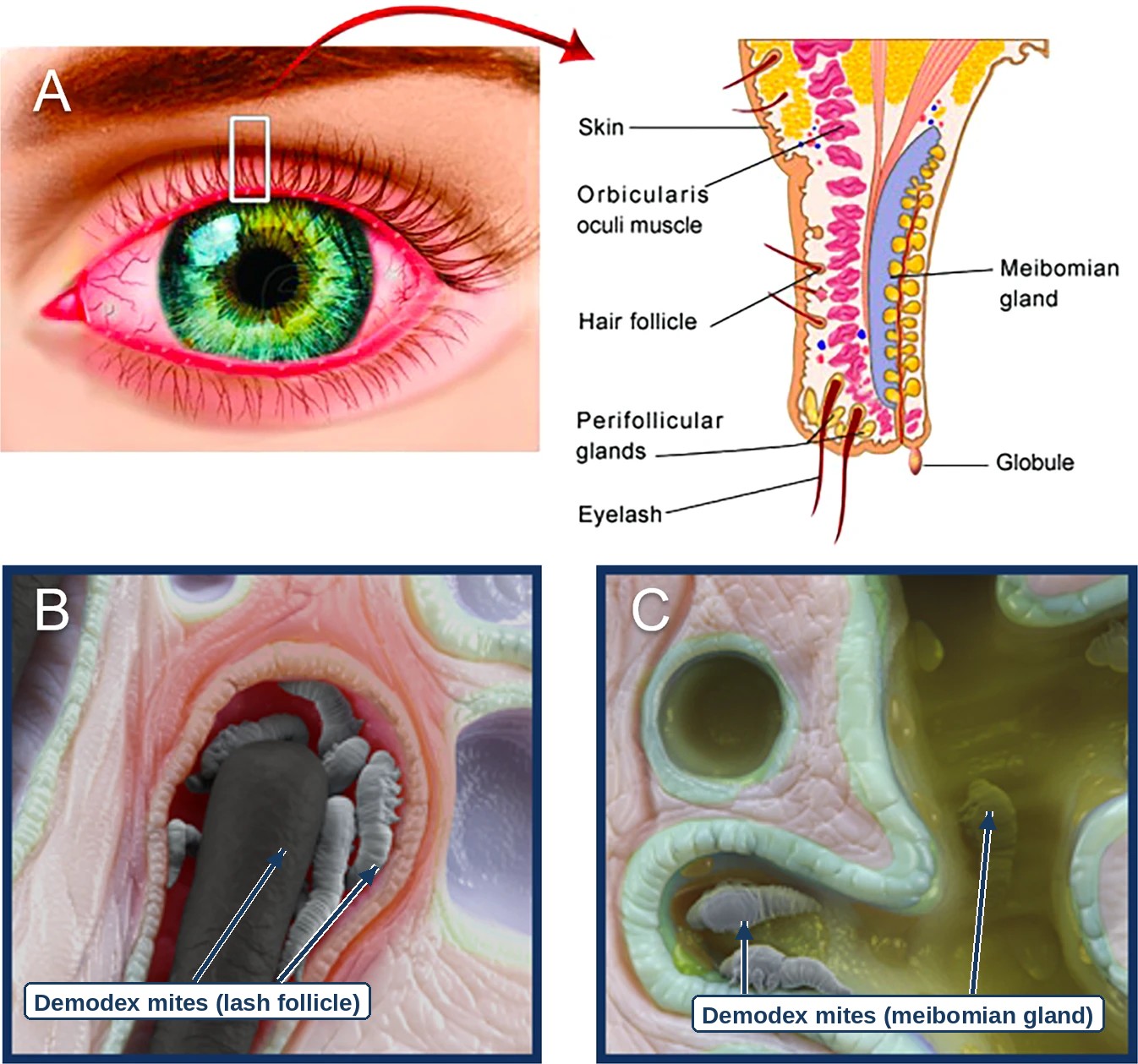 Figure from the DEPTH expert panel report: A, schematic of an eyelash follicle and its glands; B, Demodex folliculorum mites clustered around an eyelash inside the follicle; C, Demodex brevis mites inside a meibomian gland. Arrows added to mark the mites.