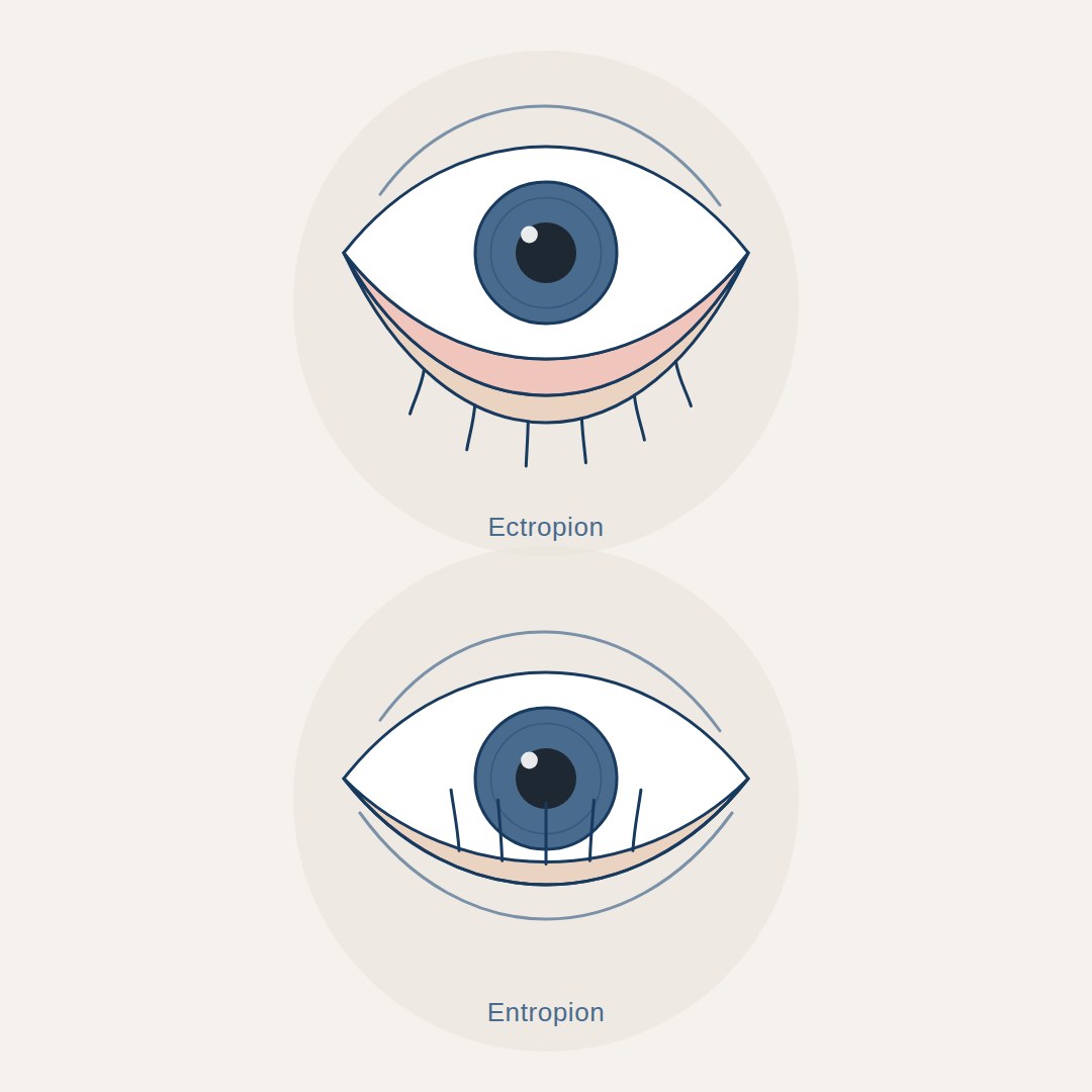 Illustration of eyelid anatomy comparing a normal eyelid with ectropion (lid turned outward), entropion (lid turned inward) and lagophthalmos (incomplete closure)