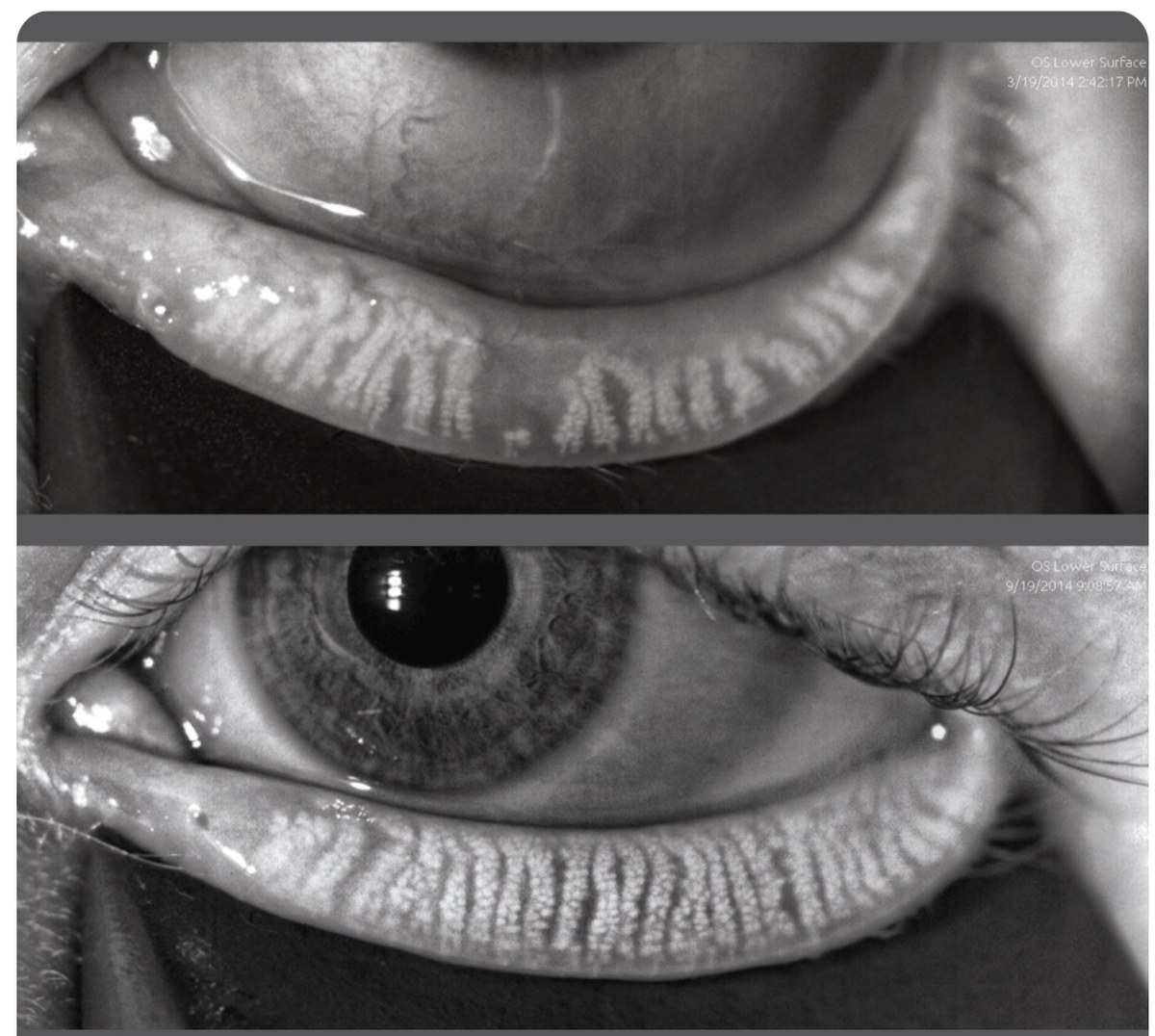 Meibografía del mismo párpado inferior fotografiado en marzo y septiembre de 2014, que muestra las glándulas de Meibomio como franjas verticales claras dentro del párpado