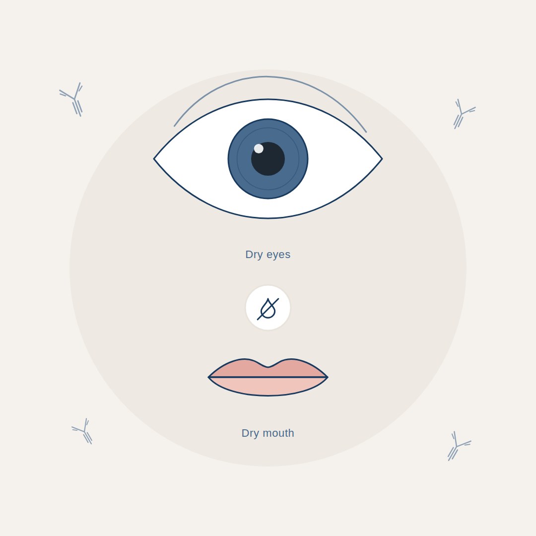 Illustration of Sjogren's syndrome showing the lacrimal tear gland and salivary glands affected by autoimmune inflammation, with a dry eye and dry mouth