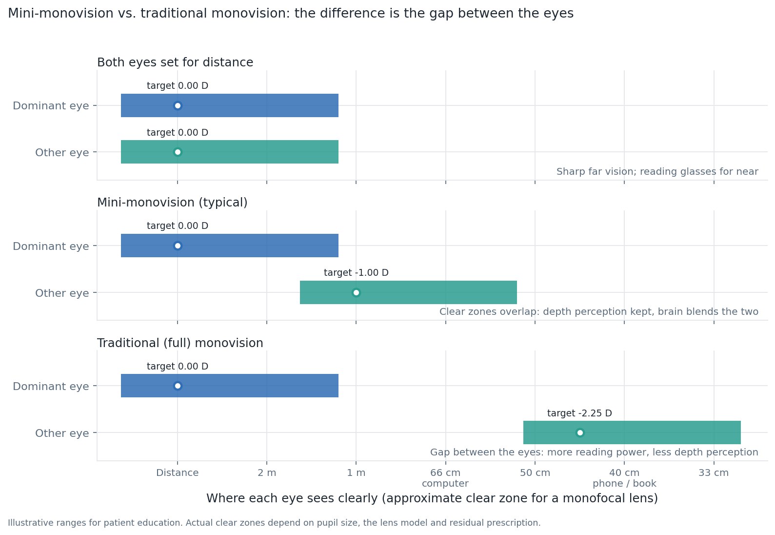Diagram comparing where each eye sees clearly with both eyes set for distance, with mini-monovision, and with traditional full monovision